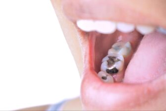 虫歯や銀歯が多い人の口腔内写真