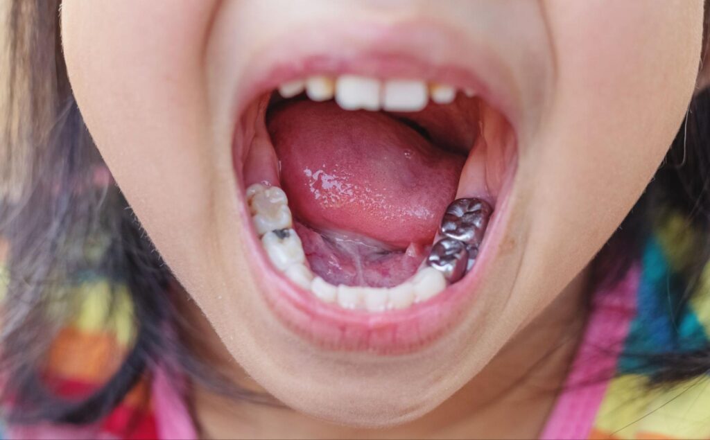 虫歯や銀歯のある子どもの口の中