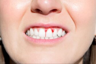 歯周病が進行し歯茎から血が出ている様子