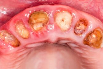 重度の虫歯で複数の歯の歯冠が崩れた状態の口腔内の写真
