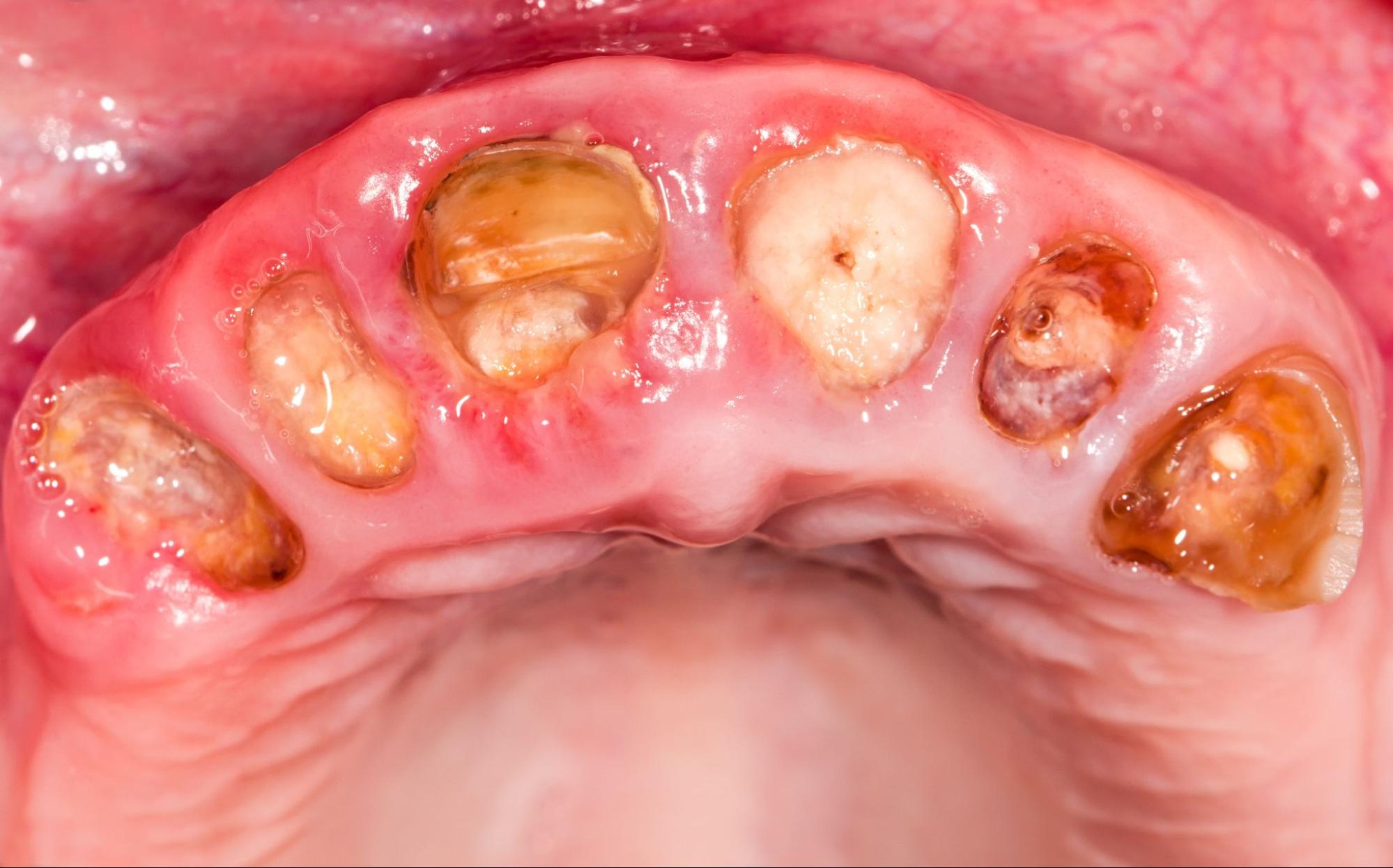 重度の虫歯で複数の歯の歯冠が崩れた状態の口腔内の写真