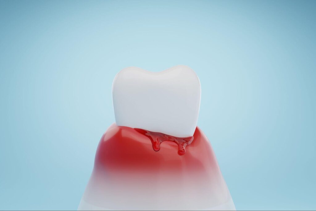 手遅れの歯周病でぶよぶとの歯茎から血が出ている様子