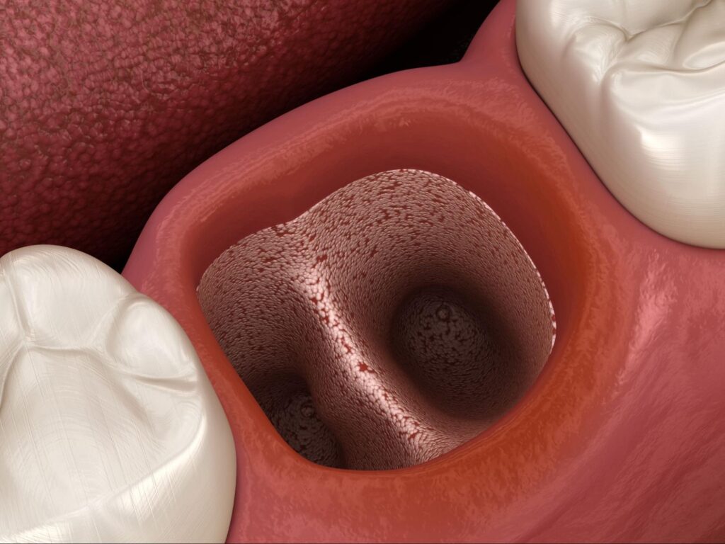 抜歯したあとの歯茎